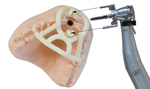 Insertion de la pièce à main guidée sur le modèle