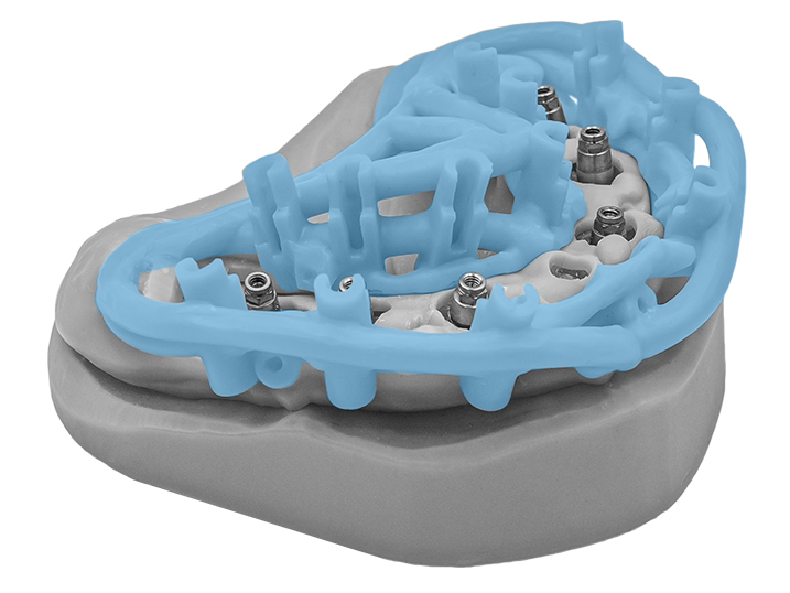 Guide chirurgical 2INGIS sur modèle, vue occlusale